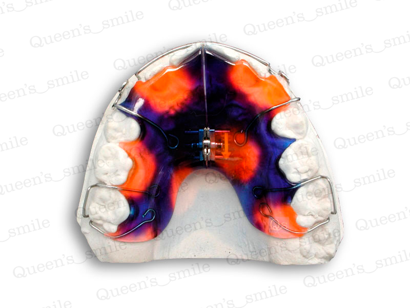 Smiler R43 Galerie - Queens smile