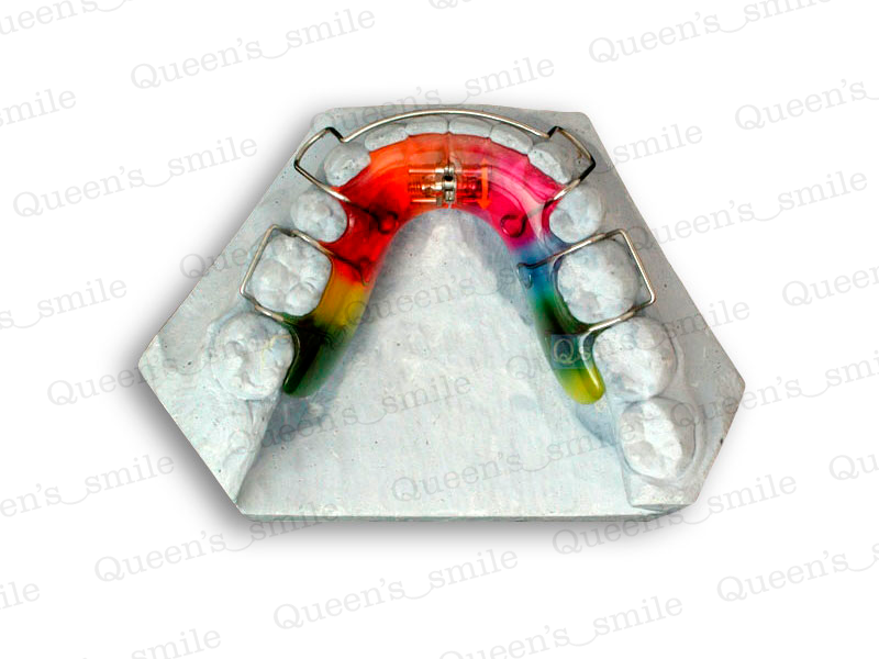 Smiler R43 Galerie - Queens smile
