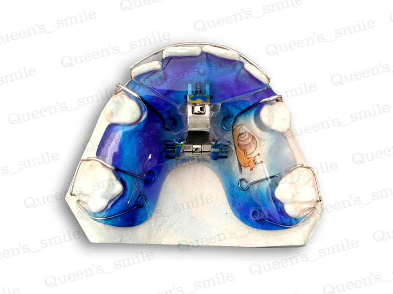 Smiler R43 Galerie - Queens smile